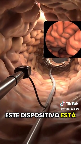 Colonoscopy Procedure Explained | 3D Medical Animation #Colonoscopy #DigestiveHealth #MedicalAnimation #3DMedical #HealthEducation #CancerScreening #Anatomy3D #MedicalVideo #Healthcare #prevention