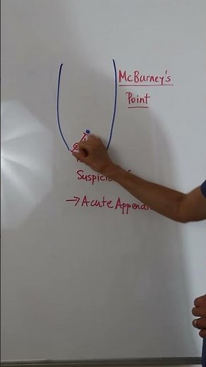 McBurney's Point #nursingschoolclinicals #anatomyandphysiology #nursingstudent