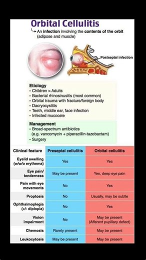 @theeyecareoptom on Instagram: "Orbital cellulitis 👀 . . . #medicallife #eyes #eyecare #ophthalmology #optometry"