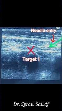 Modified PEC block (serrato-pectoral & interpectoral) by Dr.Sairah sadaf for mastectomy