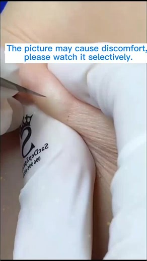 #satisfying #tiktok #pimple #pimplepopper2021 #pimplepopper #cystpopping #acne #skincare #fyp #removal #pimplepop #pimpleremover