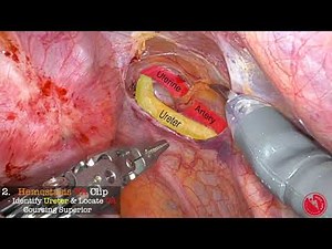 Robotically Assisted Laparoscopic Myomectomy • Video • MEDtube.net