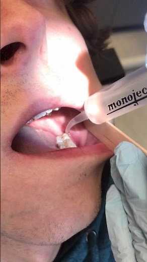 Irrigating Sockets After Wisdom Tooth Removal - Oral Surgery Of The Rockies -Highlands Ranch