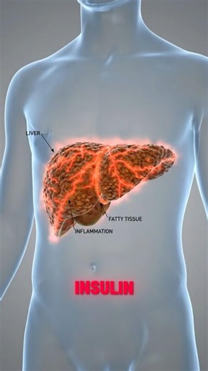 Why Your Liver Hates High Fructose Corn Syrup ⚠️