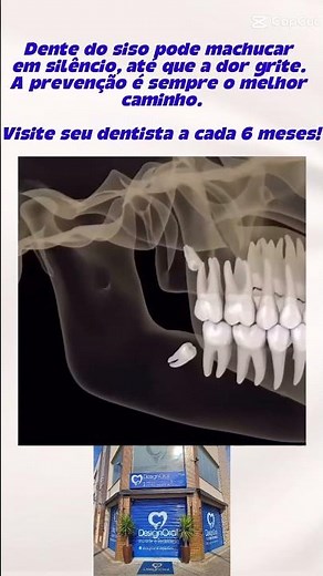 Dente do siso: Uma possível dor adormecida, pergunte ao seu dentista antes do problema aparecer
