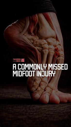 A Commonly Missed Midfoot Injury - A Lisfranc injury is a commonly missed midfoot injury where disruption of the Lisfranc ligament and joint complex alters foot stability and force transfer, often mistaken for a simple sprain. | The Brain Maze