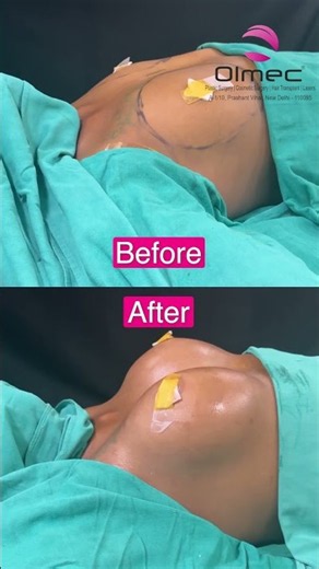 Breast Transformation ✨ | Before & After Breast Augmentation