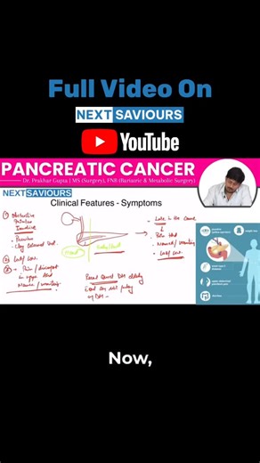 NEXT Saviours on Instagram: "Severe back pain in pancreatic cancer often signals advanced disease with retroperitoneal nerve involvement. Late-stage patients may also present with jaundice and a palpable mass. #PancreaticCancer #CancerAwareness #MedicalEducation #HealthTips #AdvancedCancer"