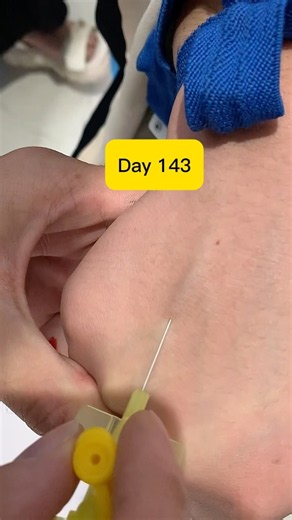 Day 143: 24G Cannula Insertion in Dorsal Hand Vein 💉 #Shorts#viralvideo #viralshorts #safai#safi