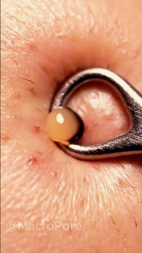 Clinical Macro Extraction | Sebum Release in 4K