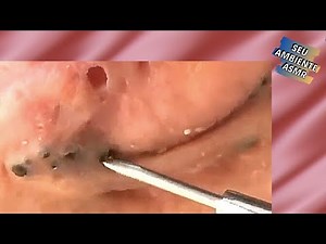 Removendo Cravos gigantes e Antigos | #030 Removing Giant Carnations | Acne treatment Satisfatório