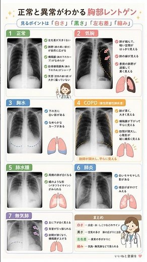 【自分の肺を守る】レントゲン写真の「白い影」や「黒い部分」の意味とは？7つの肺の異常と健康診断の結果を受け取る前に知っておきたい基礎知識