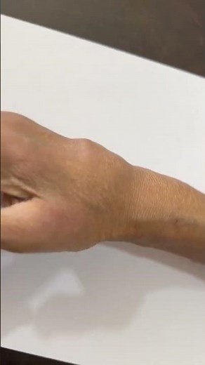 Rheumatoid Arthritis Hand Deformity | Don't Ignore Joint Pains