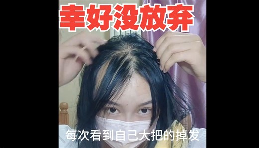 分享一下我从脱发到生发的路程……