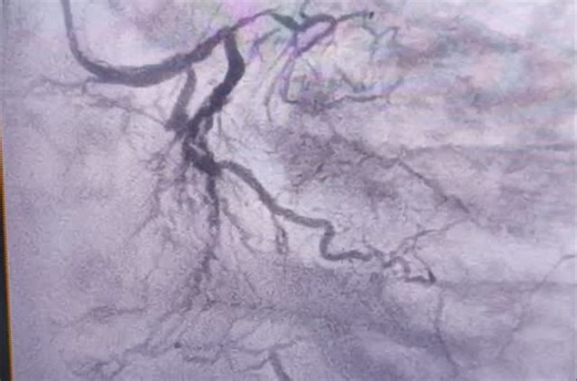 “Main road blocked… but the heart built its own highways 🌳🫀 Collateral circulation = nature’s bypass. 1.Smoking: Tobacco use significantly damages the inner lining of arteries (endothelium) and accelerates plaque formation. Diabetes: High glucose levels damage blood vessels and promote the progression of atherosclerosis.#Angiogram #Cardiology #HeartScience #CollateralCirculation | heart visual tommy