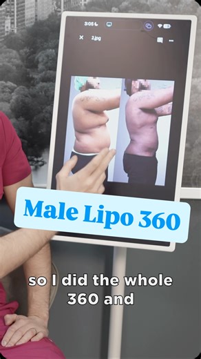 Dreams Plastic Surgery™️ | Lipo 360: Not just for the ladies! 🗽✨ Think liposuction is only for women? Think again! Lipo 360 is a game-changer for men, too. By... | Instagram