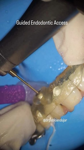 Guided Endodontic Access . . . . . . . . . @drpabloandujar | Dental Mentor