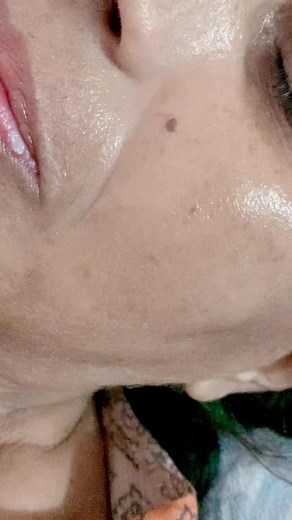 Protein thread lifting treatment.