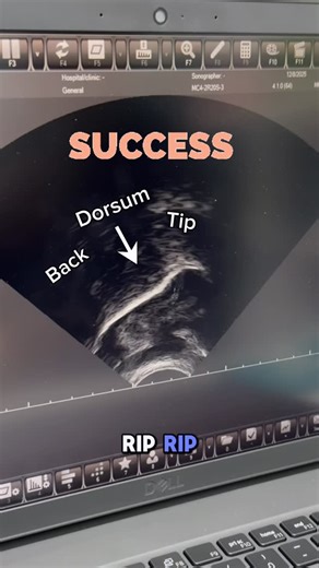 Dr. Jenn Moore •Speech•Apraxia•Myo on Instagram: "Ultrasound biofeedback session targeting lingual (tongue) positioning for R. Sometimes it’s beneficial to have kids start with just establishing the tongue shape before adding voicing!"