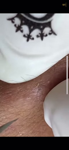 pimple.popping.vids on TikTok