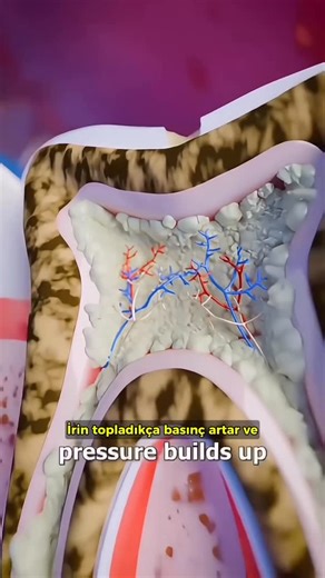 Global Hikayeler on Instagram: "Dişin içinde veya çevresinde biriken bakteriyel iltihap, zamanla apseye dönüşür. Belirtiler aniden şiddetlenebilir — bu yüzden erken müdahale çok önemlidir. ✨ Diş apsesinin en yaygın nedenleri: 🔥 Derin çürükler: Bakteriler dişin sinir tabakasına kadar ilerlediğinde iltihap başlar. 🦠 Diş eti enfeksiyonları: Gingivitis veya periodontit ilerlediğinde apse oluşabilir. ⚡️ Travma: Darbe alan dişte sinir ölür ve bölgede bakteri birikimi artar. 🪥 Yetersiz ağız bakımı: 