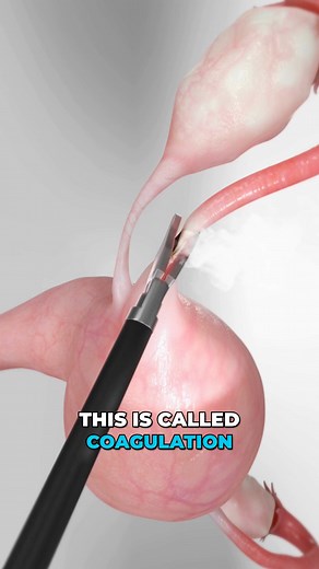 Understanding Tubal Ligation Procedures for Female Sterilization