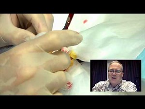 Cheeto's Cyst Removal with John Gilmore MD Live Chat!