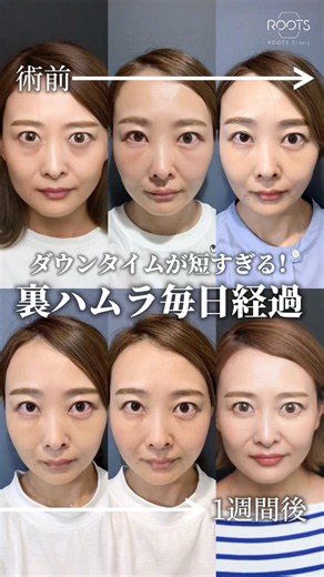 【30代女性クマ治療ダウンタイム経過】 #クマ治療 #クマ取り #目の下のクマ #裏ハムラ #rootsclinic