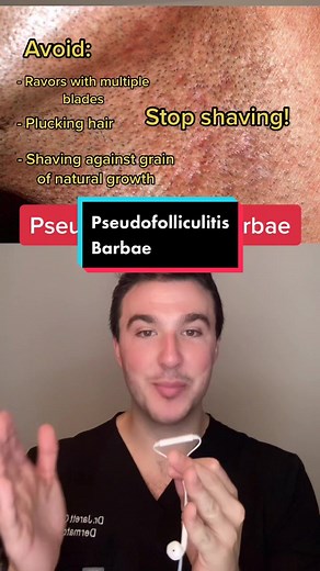 Understanding Pseudofolliculitis Barbae: Causes, Treatment, and Prevention