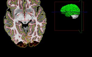 recon-all 结果出现的错误和解决思路