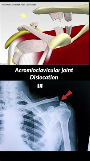 Shoulder Joint Dislocation X-ray #radiographerusn #shortvideo #xray #neet #radiology