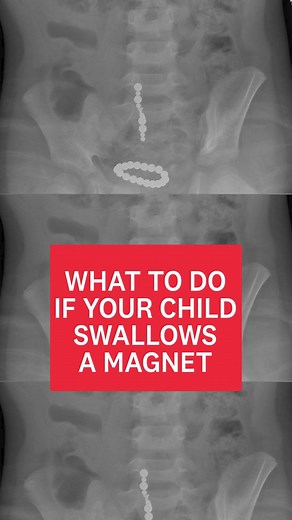 15K views · 42 reactions | ⚠️After a child almost died this week after swallowing a magnet, this is why they can be so dangerous - and what you should do if you think your child has swallowed one. ❌ Don’t make them sick ❌ Don’t give them anything to eat or drink ❌ Take them to A&E ✔️ Explain to the doctor that you think they may have swallowed a magnet. ✔️ It’s important they don't do an MRI | Which? | Facebook