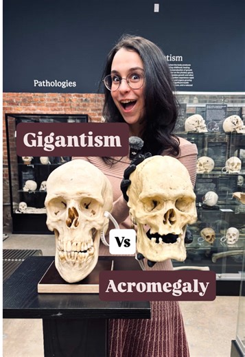 Understanding Gigantism and Acromegaly: Skeleton Differences