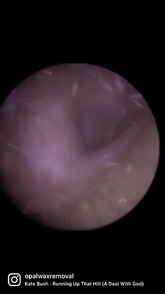Ear wax removal using endoscopic microsuctioning #SuperShow #audiologist #earwax #microsuction #nhs #private