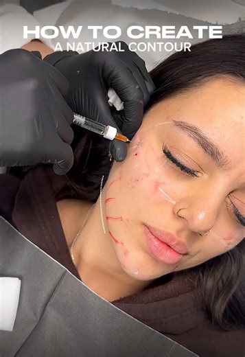 Mastering Natural Face Contouring Techniques with Fillers