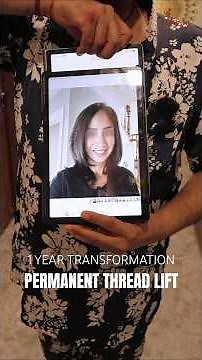 Permanent Thread Lift: A 1-Year Non-Surgical Face Lift Transformation
