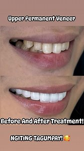 14K views · 57 reactions | Upper Fixed bridge And veneer!!!殺 | Denture Denture | Facebook