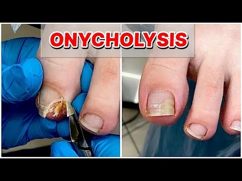 Sideways Nail Separation from Tight Shoes – Why Cleaning Is a Must!