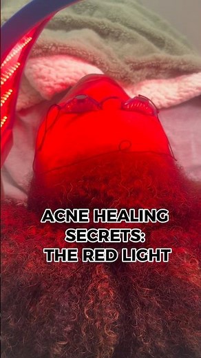 Red LED Light Therapy for Acne: The Secret to Clear Skin!
