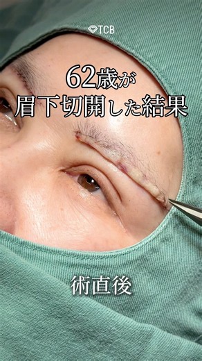 【眉下切開】最後までみて！！ #shorts