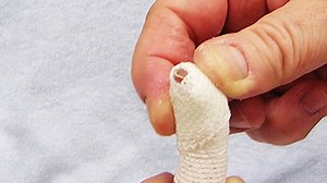 The Challenging Mallet Finger: Extensor Tendon Rehabilitation | Medbridge