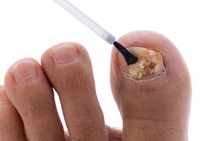 4 Types of Toenail Fungus and How To Treat Them