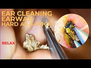 ASMR - Extreme Earwax Extraction – Hard as Stone