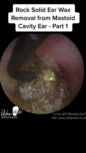 #ear #earwax #earwaxremoval #earwaxcleaning #earwaximpaction #audiologist #thewaxwhisperer