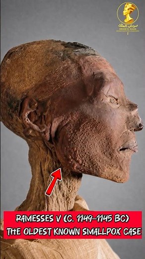 Ramesses V (c. 1149–1145 BC) — The Oldest Known Smallpox Case #egyptianmuseum #history