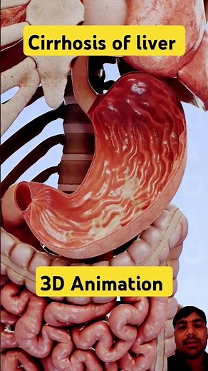 Cirrhosis of liver// 3D Animation #anatomy #anatomytuition #doctor #neet #study #shorts