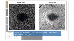 OCT angiografie (OCT A)