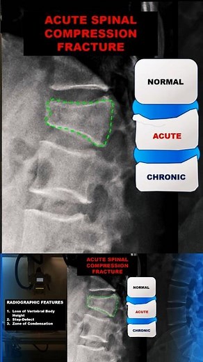 Spinal Compression Fracture on X-ray