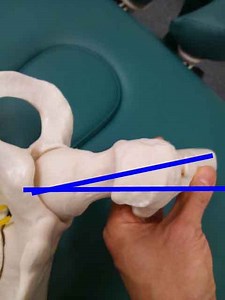 整形外科的検査法の紹介　クレイグテスト