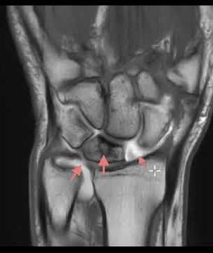 3 big findings on wrist MRI arthrogram